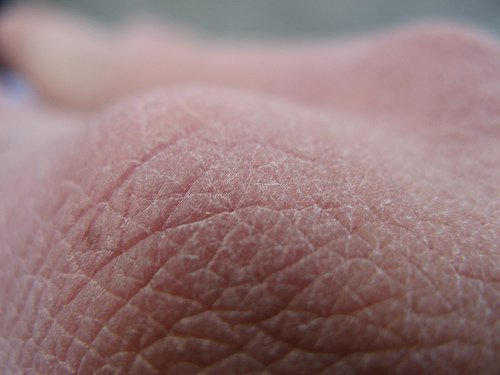 Dry skin due to a deficiency of fatty acids