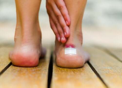 9 Natural Blister Remedies
