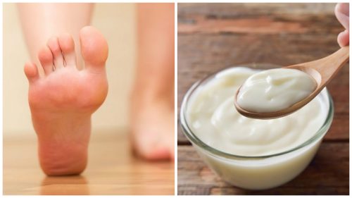 How To Remove Calluses: DIY Yogurt & Vinegar Recipe