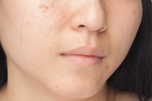 These 7 Eating Habits Are Harming Your Face