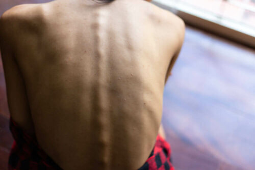 the back of a person with nutritional deficiency