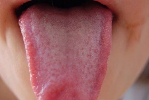Strawberry red tongue
