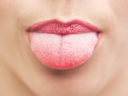 Whtie tongue