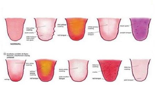 Fissured tongue: causes and treatment