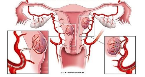 7 Warning Signs of Fibroids