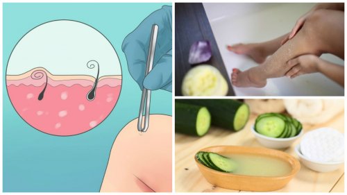5 Natural Remedies that May Help You Get Rid of Ingrown Hairs