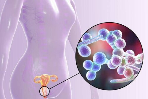 A diagram of bacterial vaginosis.