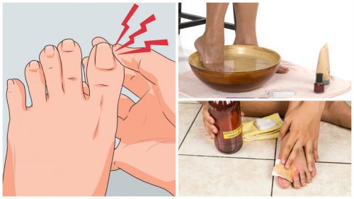 Treat Ingrown Nails with These 6 Home Remedies