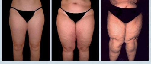 Lipedema, a Serious Disease You Should Know About
