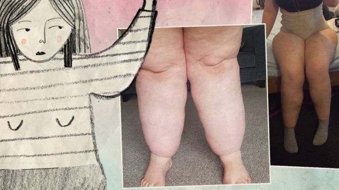 Woman with lipedema