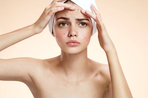 hydrogen peroxide and acne