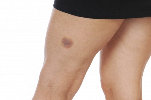 A leg with a bruise.