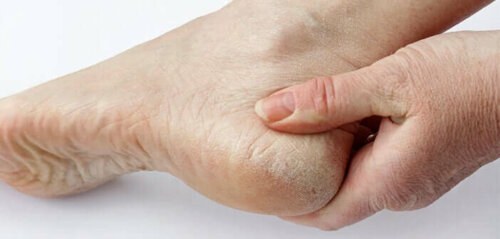 Cracked heels.