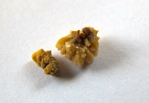 A kidney stone.