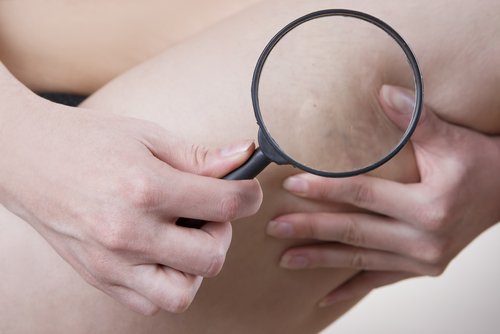 Cellulite