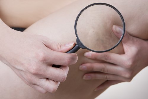 Woman grabbing cellulite looking with magnifying glass