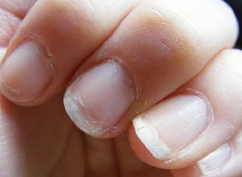 A woman with fragile nails.
