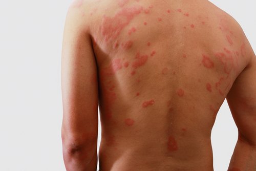 Skin issues in the back of a man