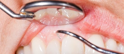 14 Reasons for Bleeding Gums