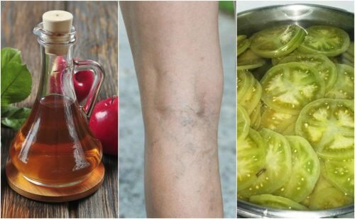 Fight Varicose Veins With This Natural Home Remedy