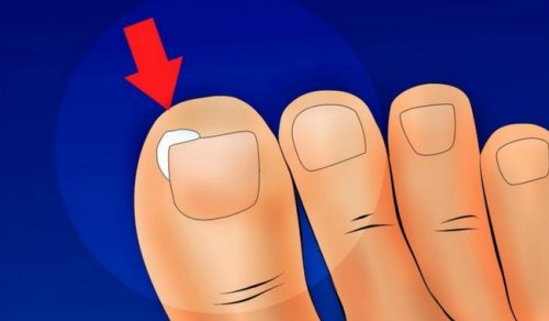 Prevent and Treat Ingrown Toenails - Learn How Here!