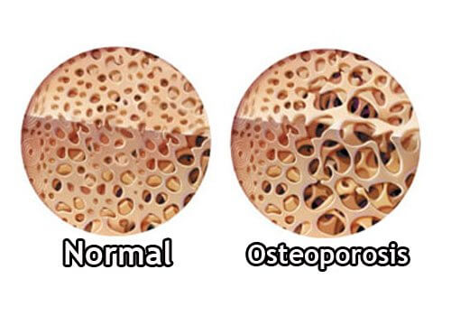 How to Control Osteoporosis During Menopause How to Control Osteoporosis During Menopause