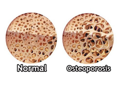 How to Control Osteoporosis During Menopause