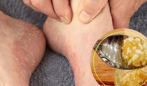 Six Natural Remedies for Athlete's Foot Relief