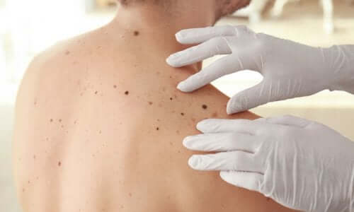 A guy with moles on his back.