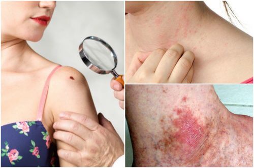 6 Skin Cancer Symptoms You Should Not Ignore