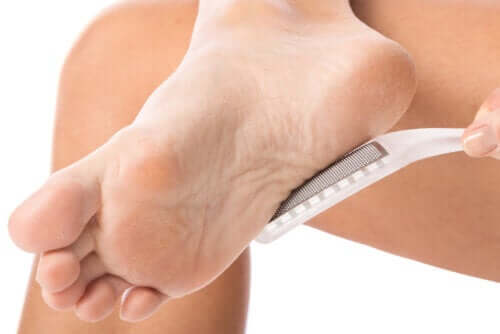 How to Remove Calluses Naturally