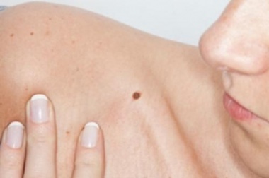 skin mole