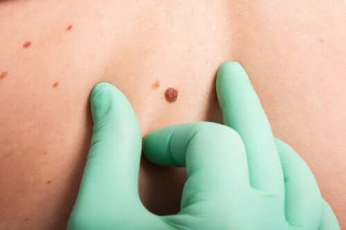 The ABCDE skin cancer test.