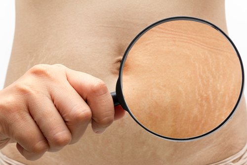 6 Tricks to Eliminate or Reduce Stretch Marks