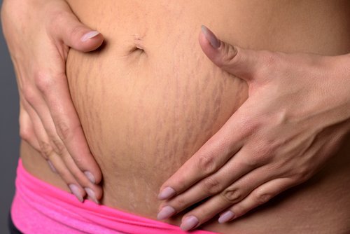 Woman with stretch marks