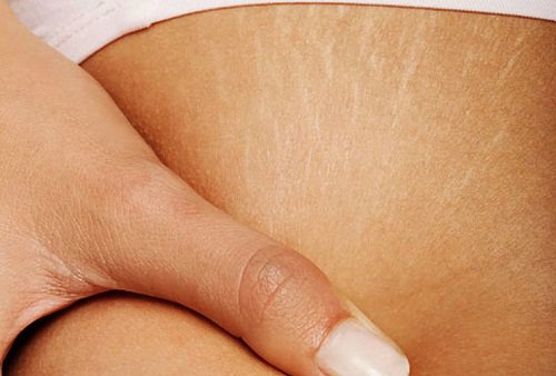 Woman with stretch marks