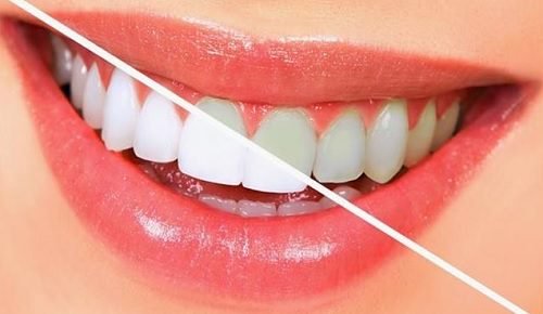 10 Foods That Whitens Teeth Naturally