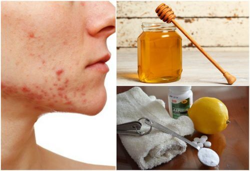 Cystic Acne: 6 Natural Remedies