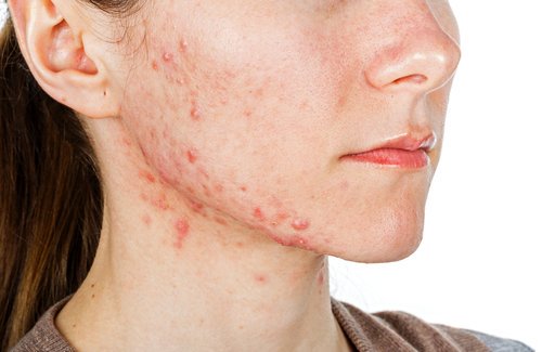 A girl with bad acne.