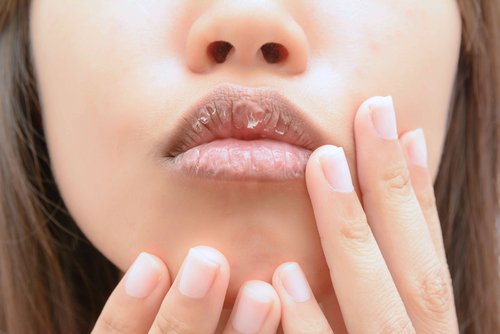 A woman with cracked lips.