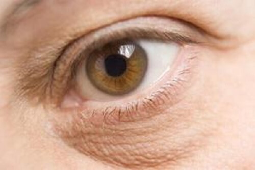 A woman with puffy eyes.