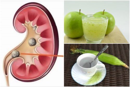 These Natural Solutions May Help Break Up Kidney Stones