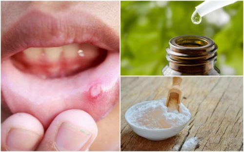 Get Relief from Mouth Ulcers with 6 Natural Remedies