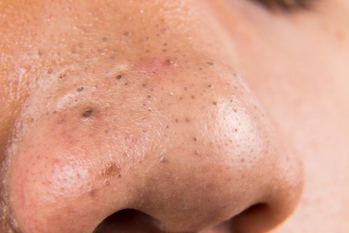 Pimples and spots on a man's nose