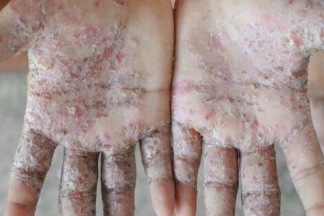 3 Easy Home Remedies to Get Rid of Scabies
