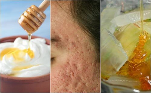 Face Masks for Pockmarks: 5 Natural Recipes That Work