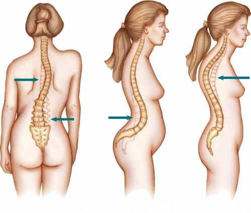 Woman with scoliosis