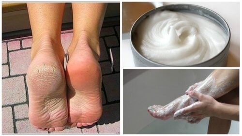 A Home Remedy for Foot Fungus and Calluses