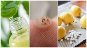 Six Powerful Homemade Wart Remedies