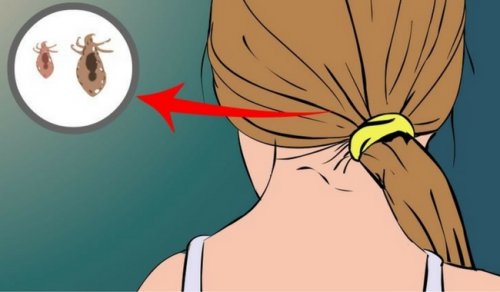 How to Get Rid of Head Lice Naturally How to Get Rid of Head Lice Naturally